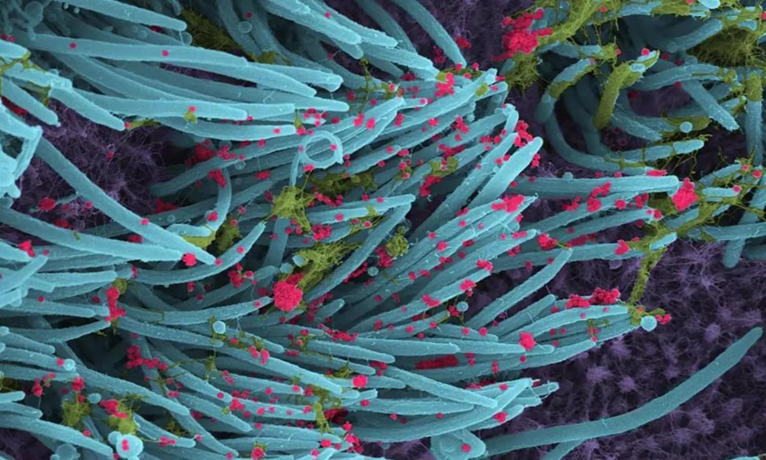 New coronavirus seen up close in graphic details inside lungs