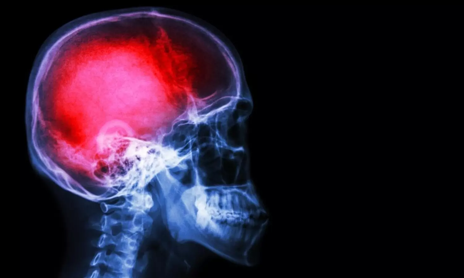 Possible link found between blast exposure and Alzheimers