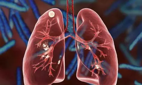 Half a million more TB deaths in 2020 due to pandemic disruptions: WHO