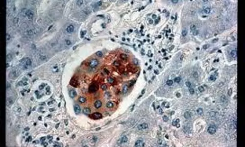 Algorithm identifies 165 genes that cause cancer