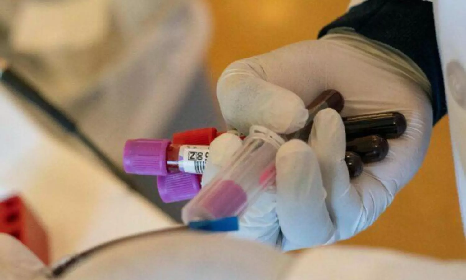 Plasma therapy no longer a recommended cure for COVID