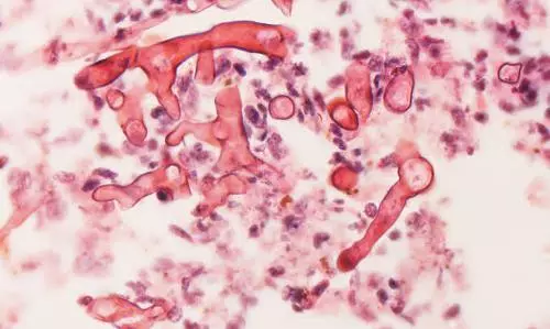 Study finds uncontrolled diabetes, improper use of steroids as major cause of black fungus