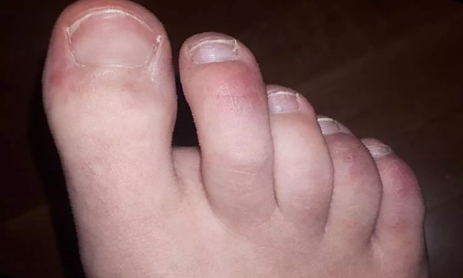 Skin condition Covid toe might be an immune response side effect: Study