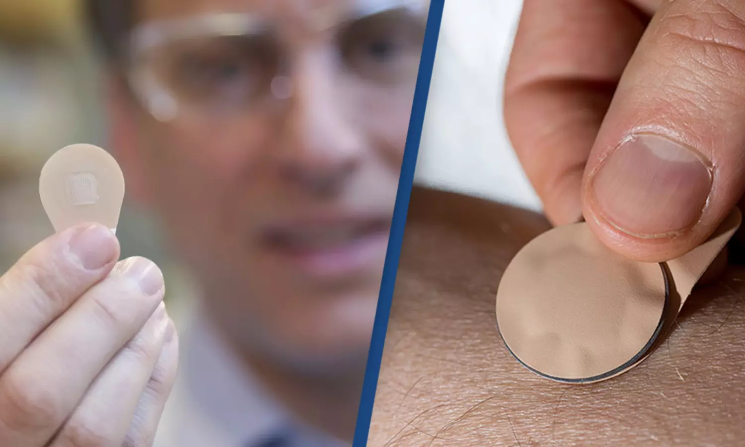Skin patches in progress to replace needle for vaccine jabs