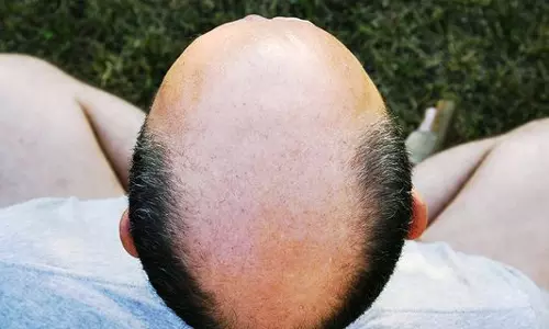 Bride in UP faints and refuses to marry a bald man