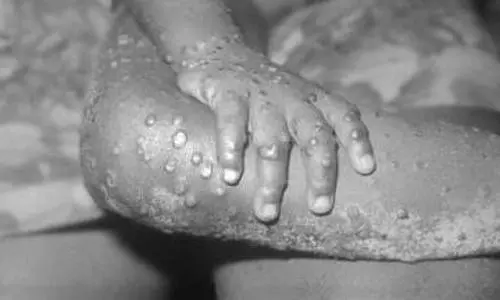 Spain, Portugal, US, Canada detect dozens of suspected monkeypox cases