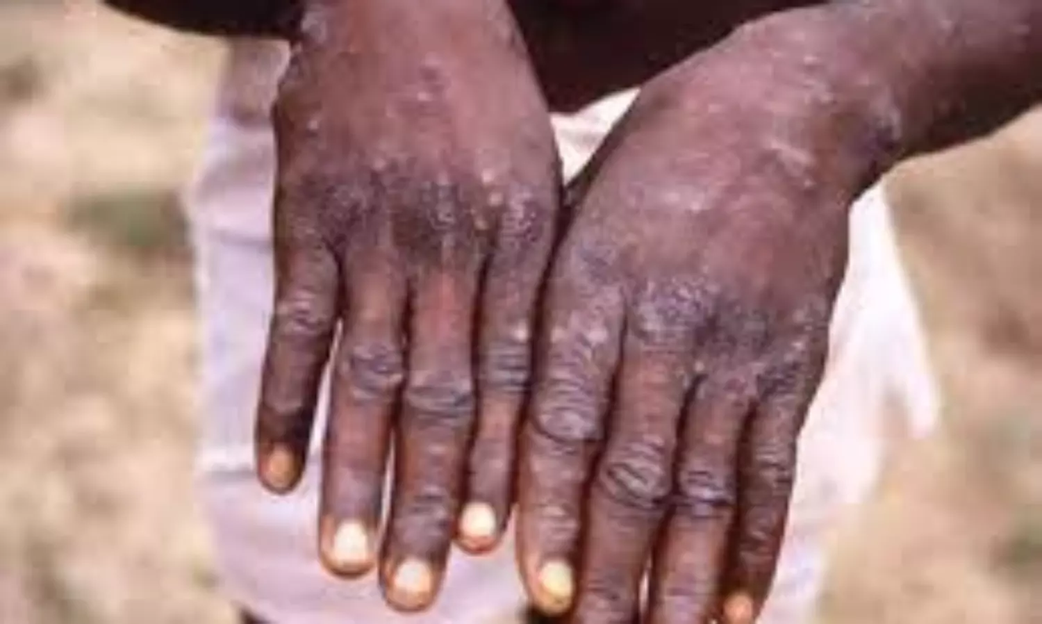 1st Monkeypox case in India confirmed in Kerala