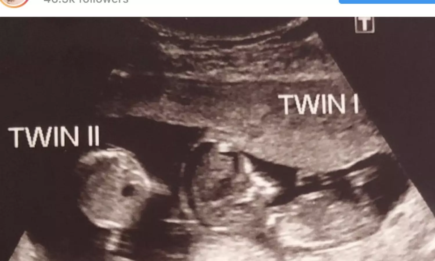 US woman becomes pregnant while already being pregnant