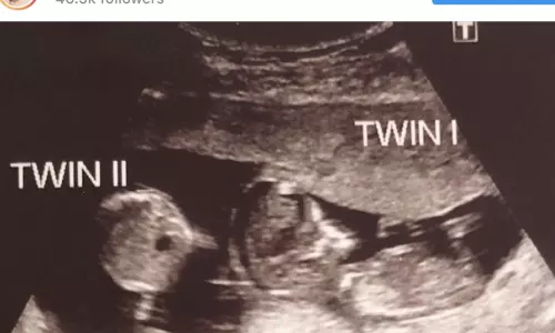 US woman becomes pregnant while already being pregnant US woman becomes pregnant while already being pregnant