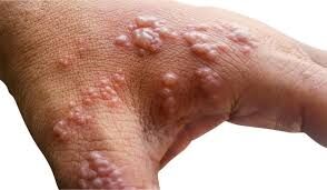 WHO to declare Monkeypox a global health emergency