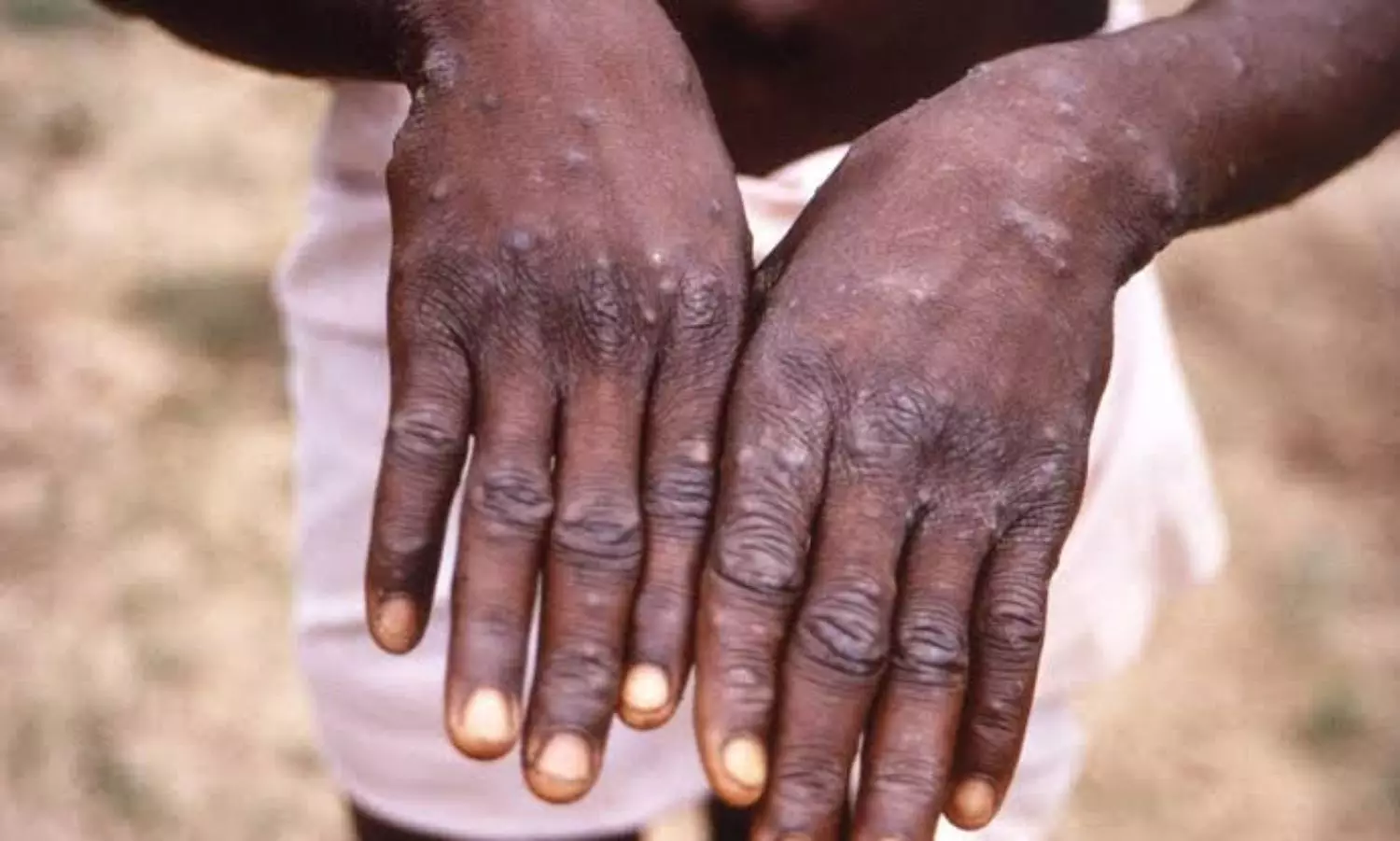Kerala reports suspected monkeypox case in UAE returnee, samples sent for testing