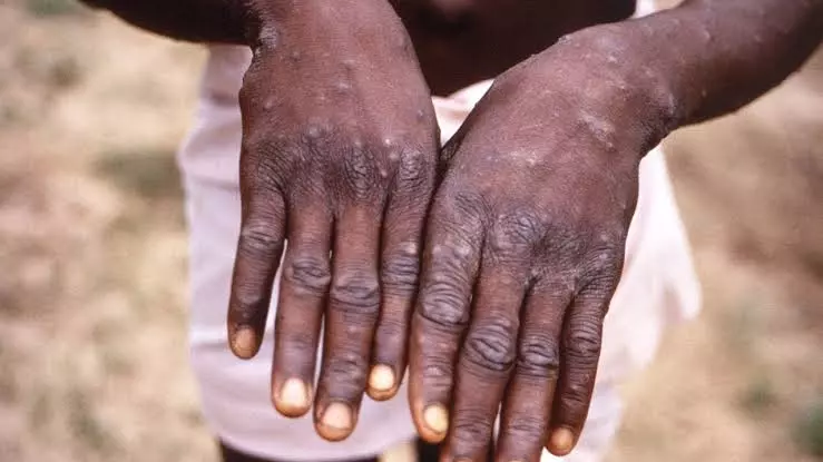 Kerala reports suspected monkeypox case in UAE returnee, samples sent for testing