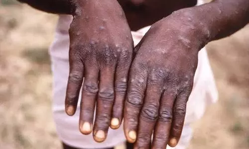 Kerala reports suspected monkeypox case in UAE returnee, samples sent for testing