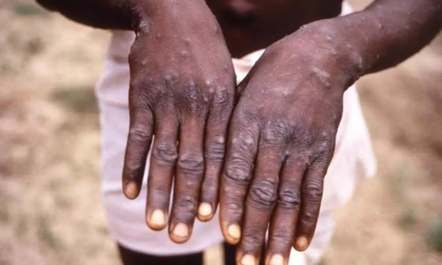 Centre asks states to screen all international arrivals after 2nd monkeypox case in India