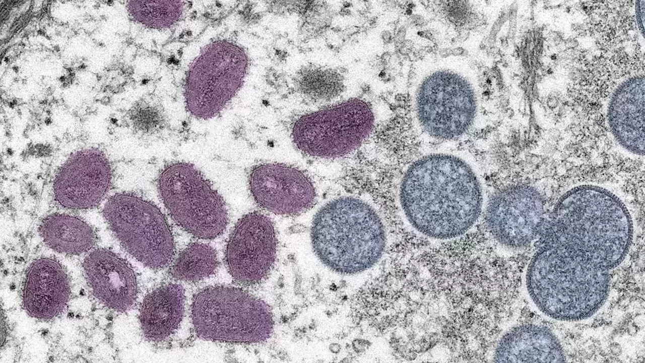 Third Monkeypox case detected in India after UAE returnee tests positive in Kerala