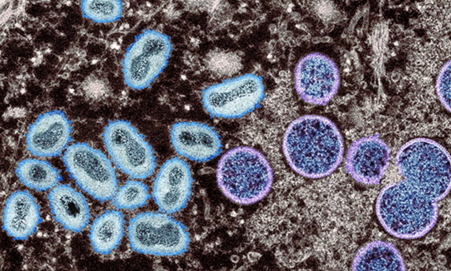 Monkeypox: Suspected Telangana patient tests negative