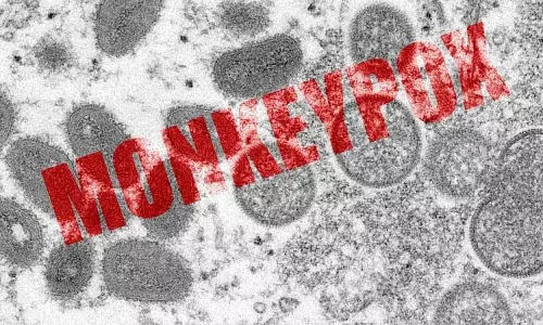 4th case in India, Delhi man without foreign travel tests positive for Monkeypox 4th case in India, Delhi man without foreign travel tests positive for Monkeypox