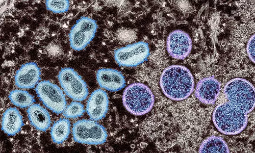 Monkeypox: Suspected Telangana patient tests negative