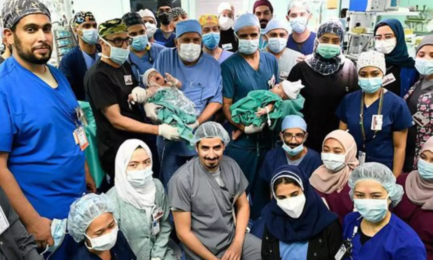 Saudi Arabia separates conjoined Yemeni twins