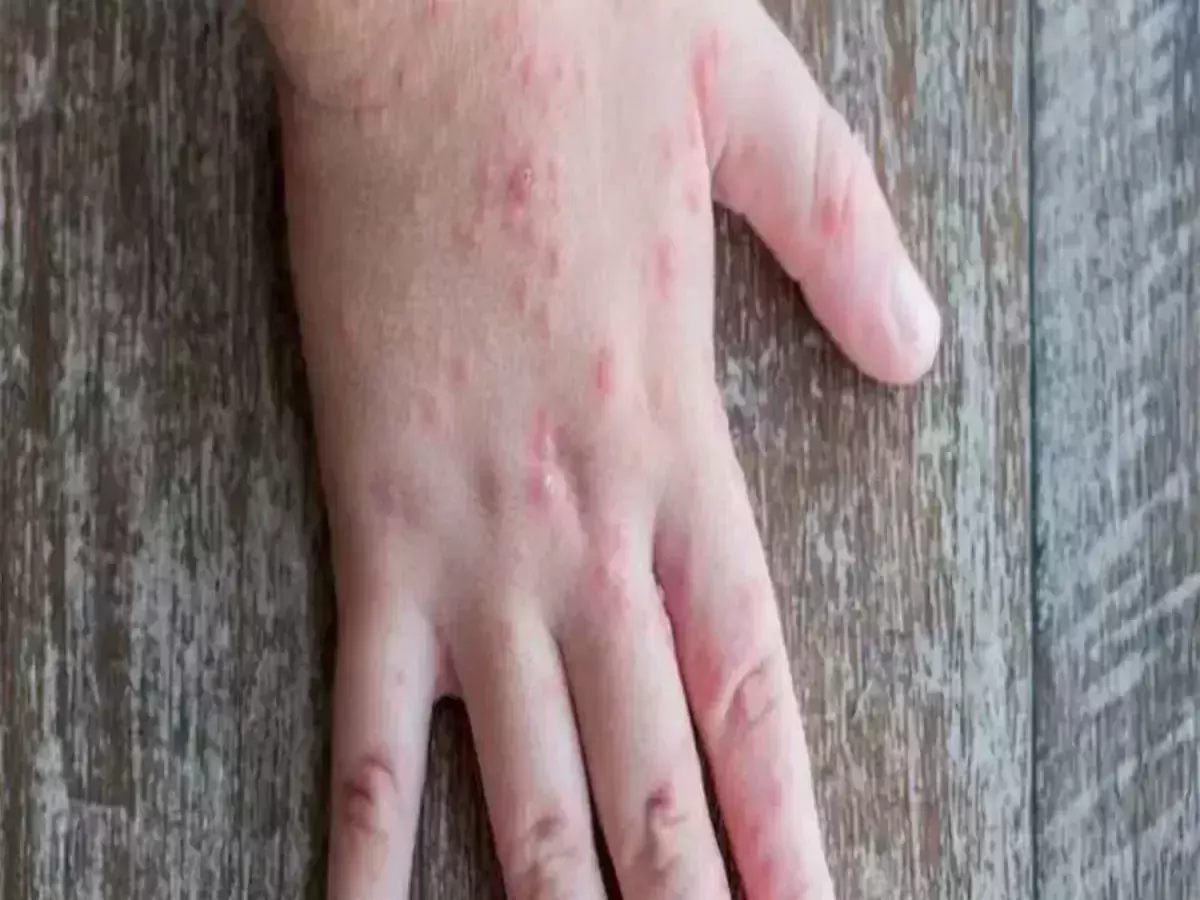 Tomato flu in children causes worry in Kerala, Leaves red painful blisters