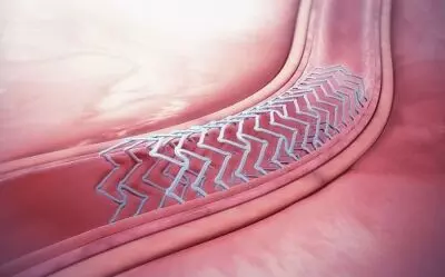 First robotically assisted bioresorbable stent insertion performed at PGI Chandigarh