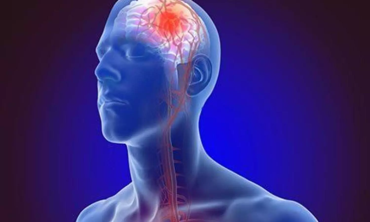 New survey says more than 85% of stroke patients are unaware of symptoms