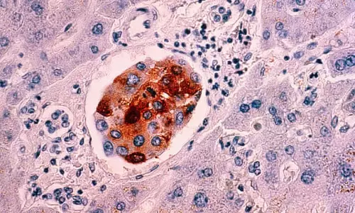 Developing breast cancer cells could be detected with tiny endo-microscope