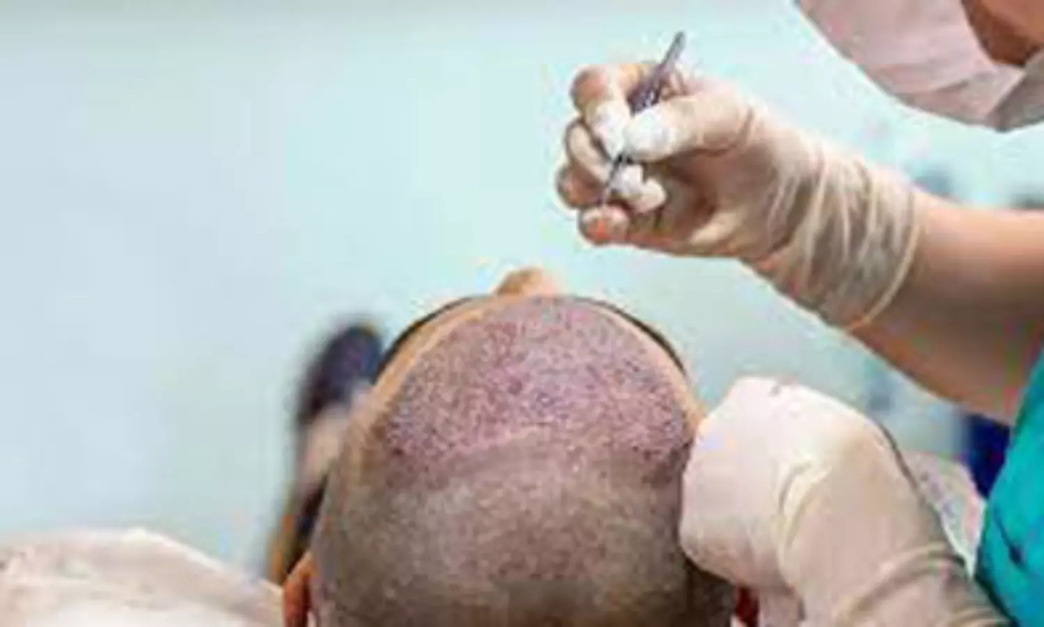 Mushrooming hair transplant clinics call for regulation: report