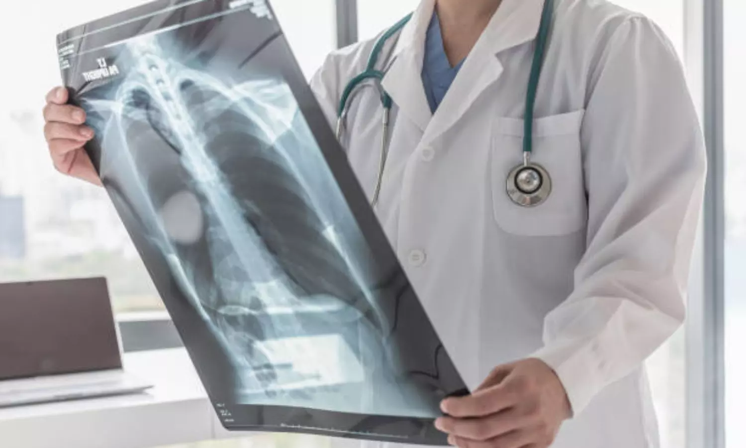 How mental health contributes to Tuberculosis bacillus