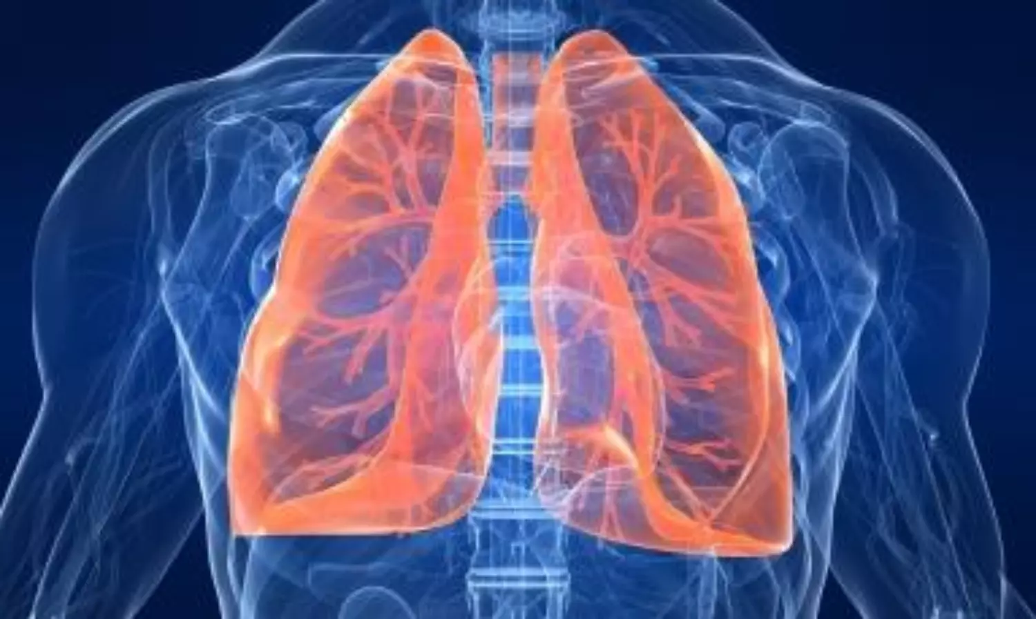 Lung cancer