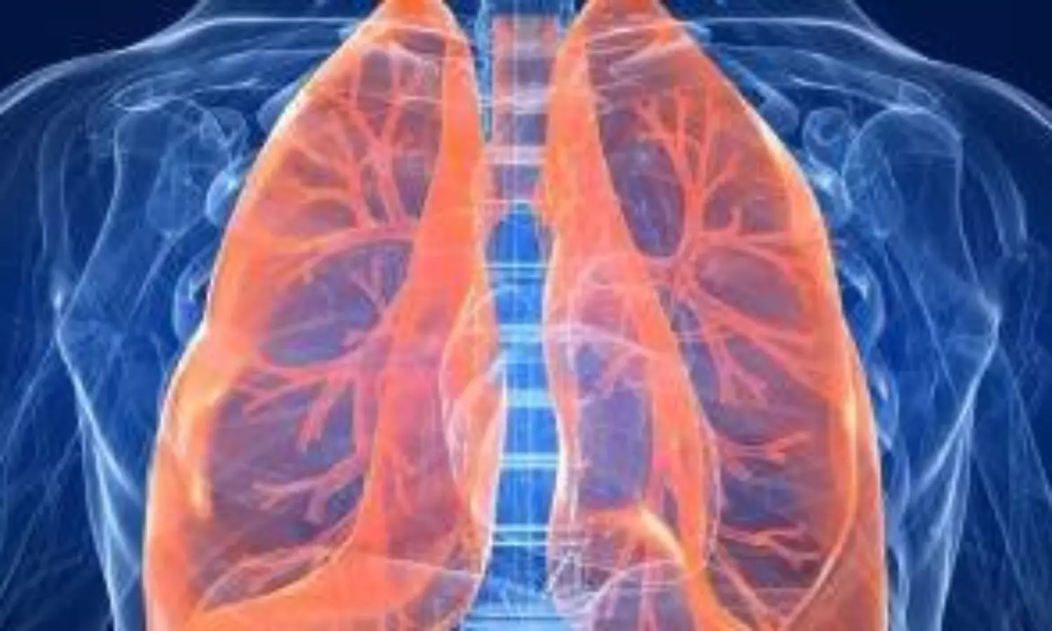 Lung cancer
