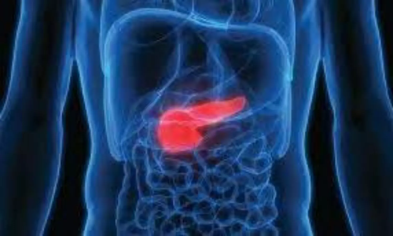 pancreatic cancer