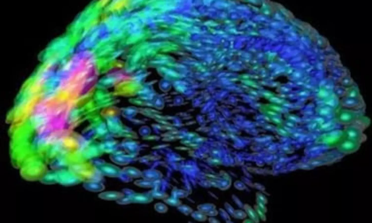 Treating schizophrenia, autism in young adults most effective: Study