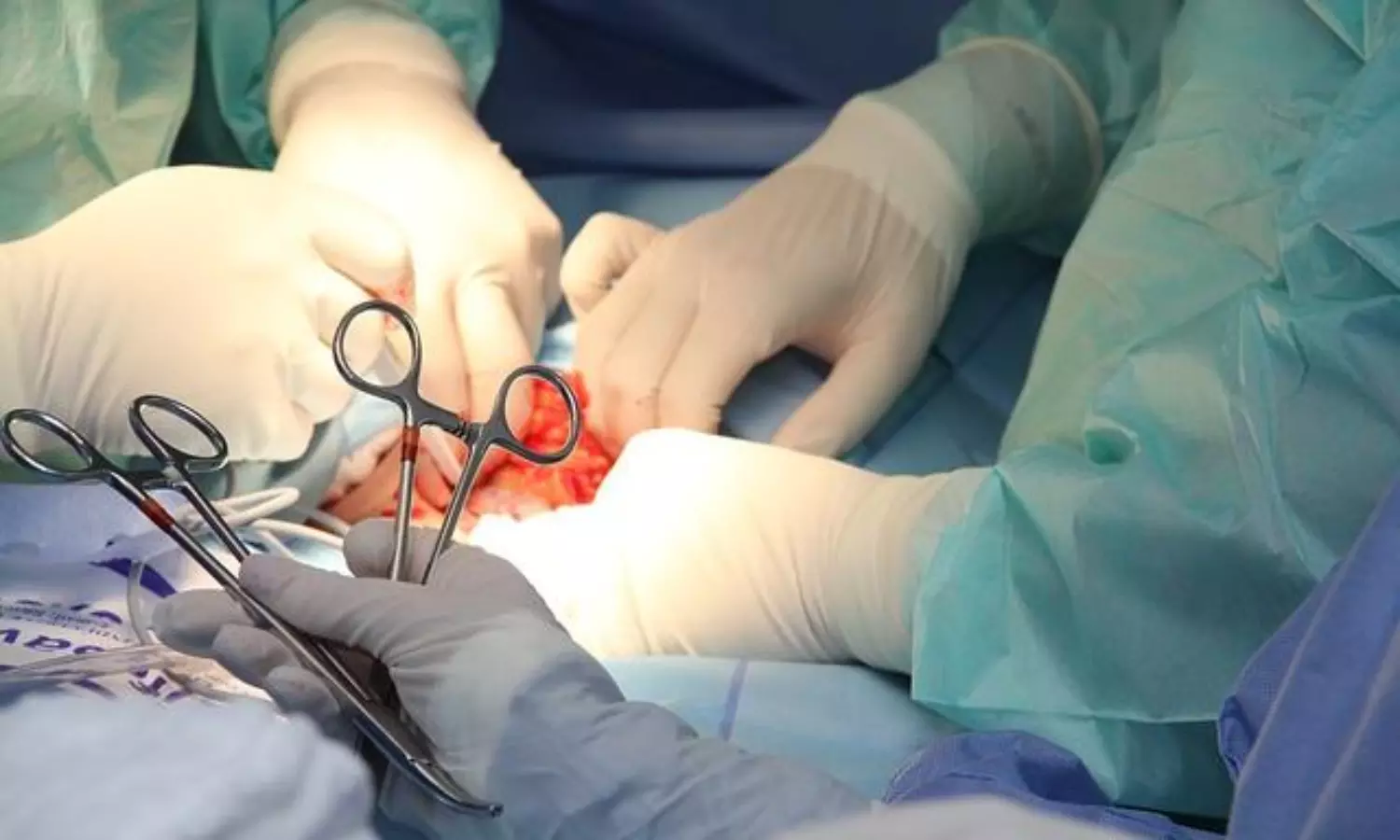 Hospital, doctors in dock over organ transplantation declaring a man brain dead