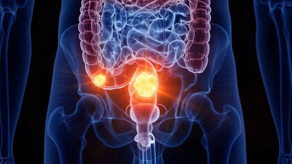 A miracle drug clears a UK woman’s aggressive bowel cancer: report