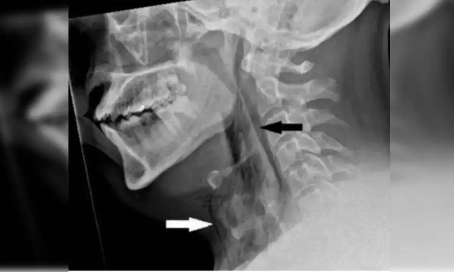 In world’s first case, man tears his windpipe after holding in sneeze