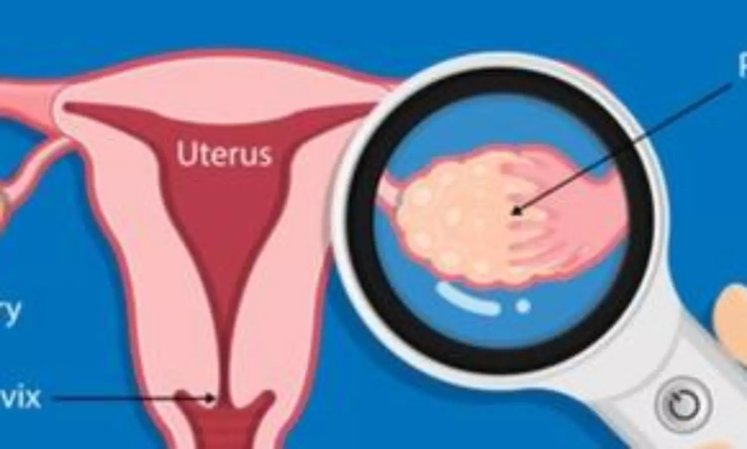 Women with PCOS more prone to have memory, thinking issues in middle age