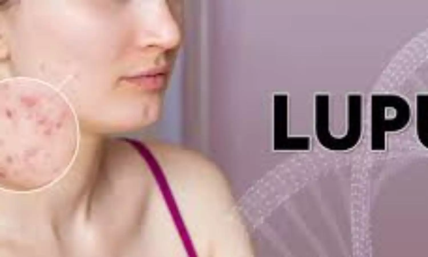 Nightmares: early symptom of autoimmune disease?