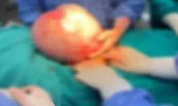 Second heaviest tumour in India removed from UP womans kidney