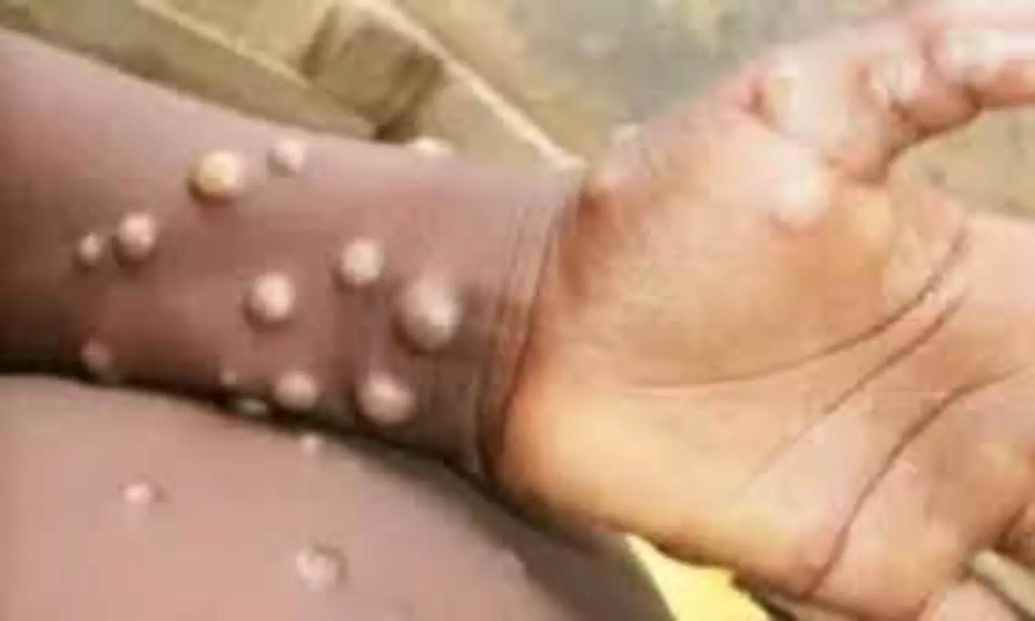 Mpox