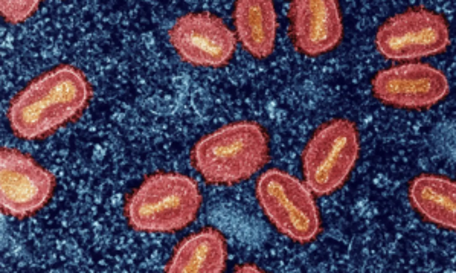 Protocol for handling monkeypox-suspected patients issued by AIIMS Delhi