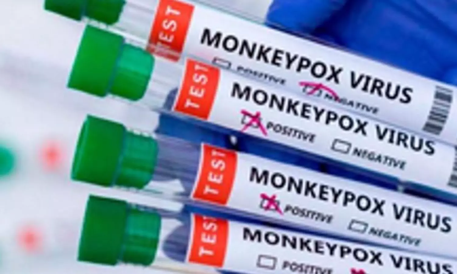 Patients condition stable as India reports suspected Mpox case: Govt