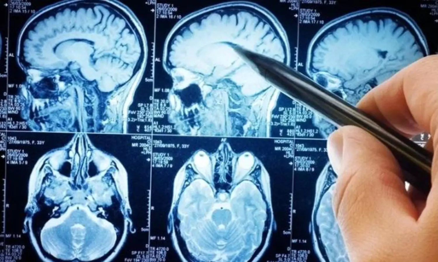 Scientists decode brain activity that can help treat anxiety and depression