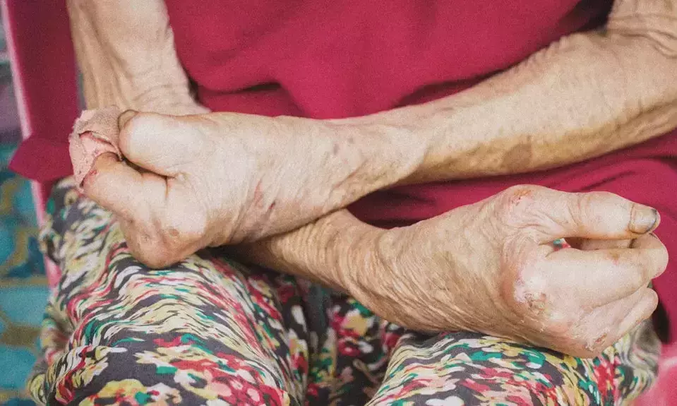 53% of Worlds leprosy cases are in India: experts warn