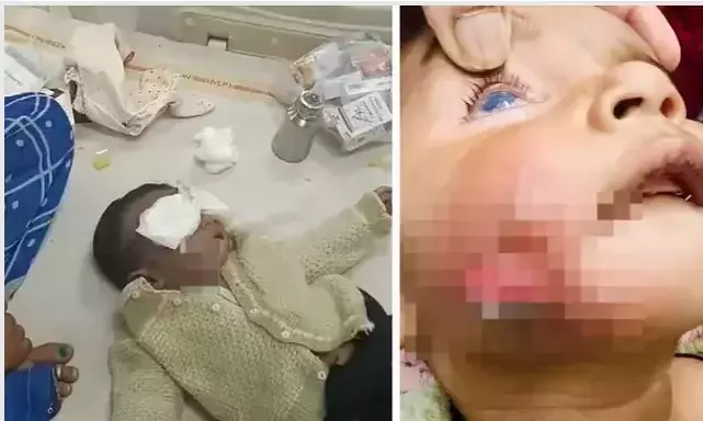 Six-month-old injured by sorcerers exorcism ritual in MP