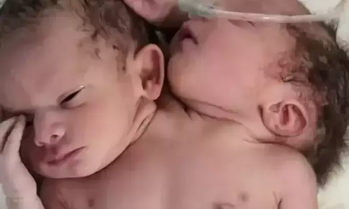 Baby girl born in Madhya Pradesh with 2 heads! Condition critical