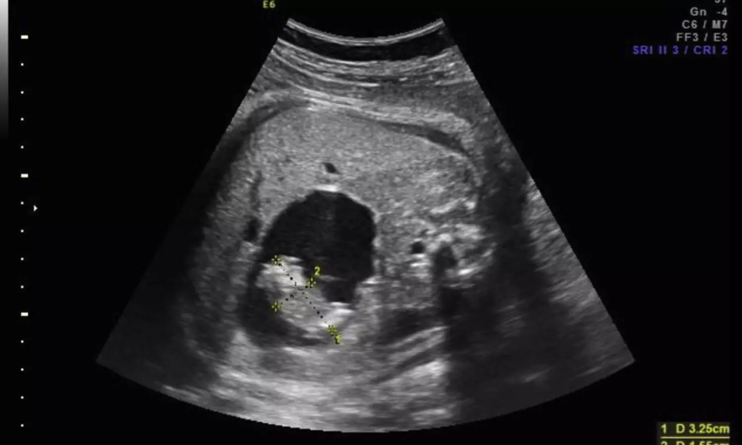 Doctors successfully remove parasitic twin fetus from newborn