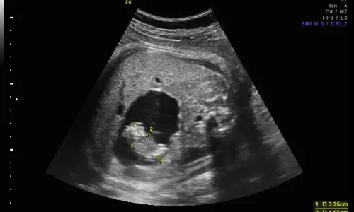 Doctors successfully remove parasitic twin fetus from newborn