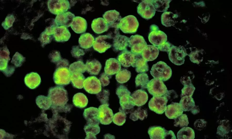 New amoebic meningoencephalitis case in Kerala; this time, Thiruvananthapuram