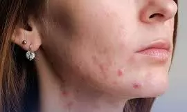 adult acne